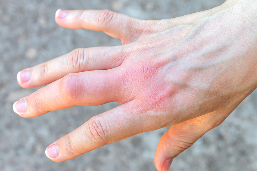 Close up of a woman's hand with a red swollen bite between her index and middle fingers.